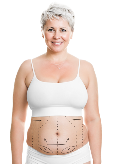 Liposuction ile Karın Germe